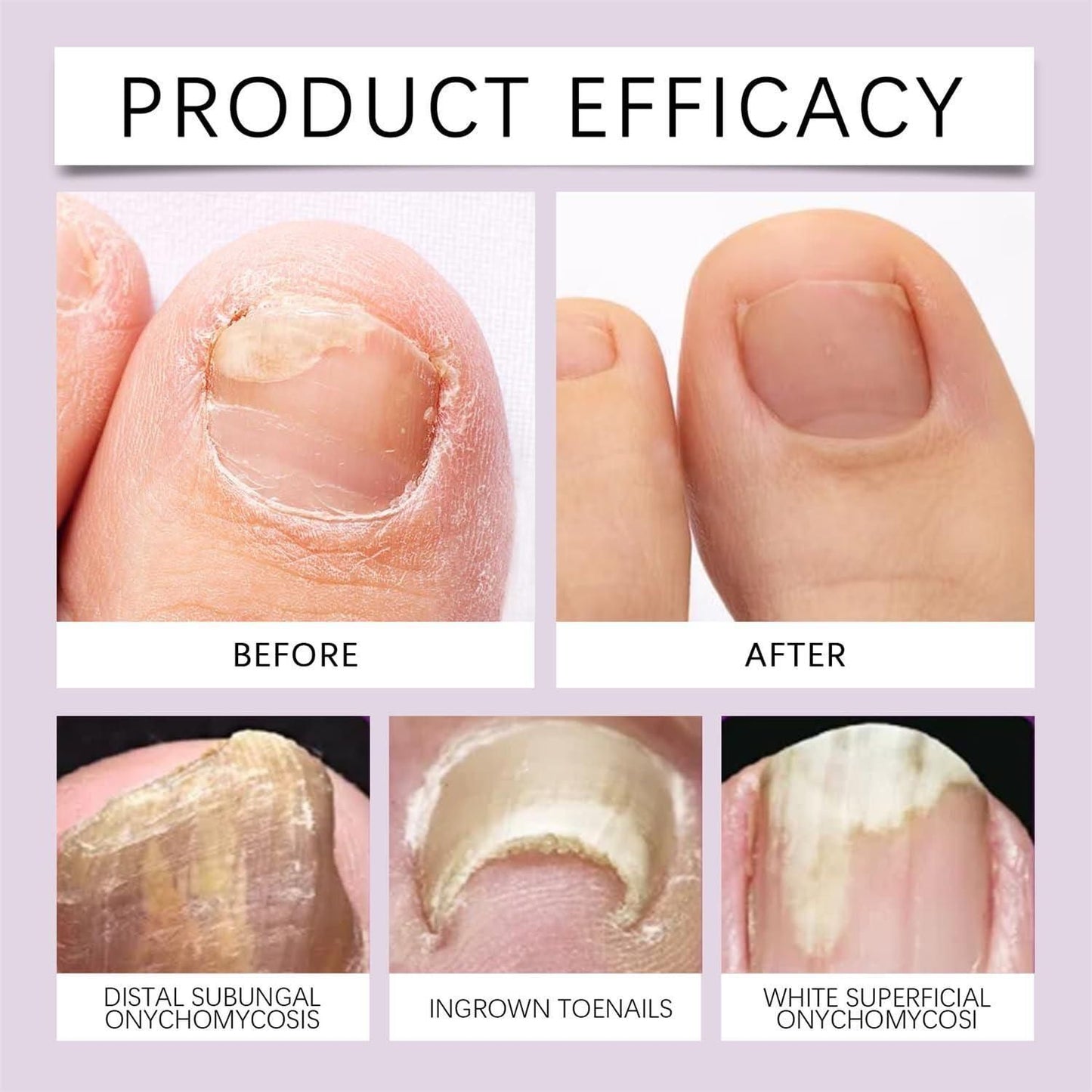 Bee Venom Nail Treatment Serum | š„BUY 1 GET 1 FREEš„